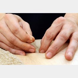 鍼を刺されると“雷”が！／（Ｃ）日刊ゲンダイ