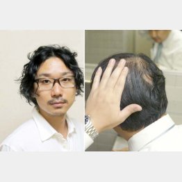ハゲたくなければ自分で作る（左は辻敦哉氏）／（Ｃ）日刊ゲンダイ