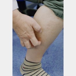 チクチクして脚がかゆい！（Ｃ）日刊ゲンダイ