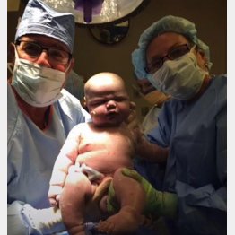 帝王切開で元気に誕生（フェイスブックから）