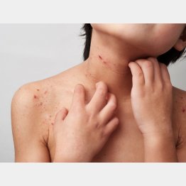 アトピーの治療薬はブロックバスター確実か