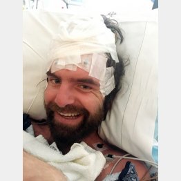 世界でわずか120症例しか報告されていない（タイソン・ボッテナスさん、＝フェイスブックから）