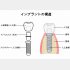インプラントの構造