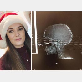 ルネ・ラビリエールさん（左）と鍵が刺さった時のX線写真（ルネさんのフェイスブックから）