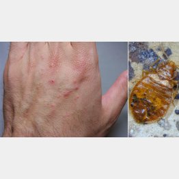 怪しい虫刺されには要注意（提供写真）