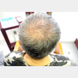 髪は生えても…（Ｃ）日刊ゲンダイ