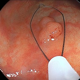 ポリープをスネア（ワイヤ器具）で切除する場面（渡海医師提供）