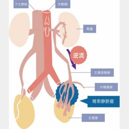 精索静脈瘤の仕組み（提供写真）