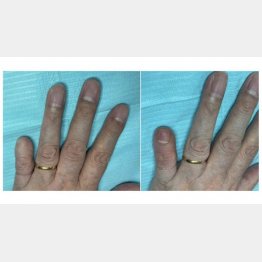 事故で欠損したツメをアートメイクで再現（BMCクリニック提供）